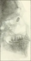 An illustration from Gunshot Roentgenograms : Acollection of Roentgenograms taken in Constantinople during the Turko-Balkan War, 1912-1913, illustrating some gunshot wounds in the Turkish Army (1916)