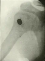 An illustration from Gunshot Roentgenograms : Acollection of Roentgenograms taken in Constantinople during the Turko-Balkan War, 1912-1913, illustrating some gunshot wounds in the Turkish Army (1916)