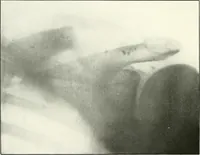 An illustration from Gunshot Roentgenograms : Acollection of Roentgenograms taken in Constantinople during the Turko-Balkan War, 1912-1913, illustrating some gunshot wounds in the Turkish Army (1916)