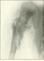 An illustration from Gunshot Roentgenograms : Acollection of Roentgenograms taken in Constantinople during the Turko-Balkan War, 1912-1913, illustrating some gunshot wounds in the Turkish Army (1916)