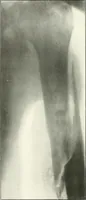 An illustration from Gunshot Roentgenograms : Acollection of Roentgenograms taken in Constantinople during the Turko-Balkan War, 1912-1913, illustrating some gunshot wounds in the Turkish Army (1916)