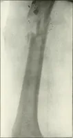 An illustration from Gunshot Roentgenograms : Acollection of Roentgenograms taken in Constantinople during the Turko-Balkan War, 1912-1913, illustrating some gunshot wounds in the Turkish Army (1916)