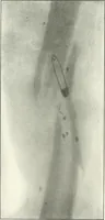 Picture 82 of 146 from Gunshot Roentgenograms : Acollection of Roentgenograms taken in Constantinople during the Turko-Balkan War, 1912-1913, illustrating some gunshot wounds in the Turkish Army (1916), leaf 194