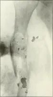 An illustration from Gunshot Roentgenograms : Acollection of Roentgenograms taken in Constantinople during the Turko-Balkan War, 1912-1913, illustrating some gunshot wounds in the Turkish Army (1916)