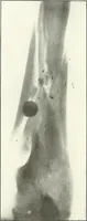 An illustration from Gunshot Roentgenograms : Acollection of Roentgenograms taken in Constantinople during the Turko-Balkan War, 1912-1913, illustrating some gunshot wounds in the Turkish Army (1916)