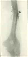 An illustration from Gunshot Roentgenograms : Acollection of Roentgenograms taken in Constantinople during the Turko-Balkan War, 1912-1913, illustrating some gunshot wounds in the Turkish Army (1916)