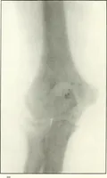 An illustration from Gunshot Roentgenograms : Acollection of Roentgenograms taken in Constantinople during the Turko-Balkan War, 1912-1913, illustrating some gunshot wounds in the Turkish Army (1916)