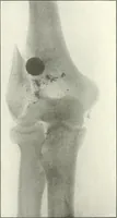 An illustration from Gunshot Roentgenograms : Acollection of Roentgenograms taken in Constantinople during the Turko-Balkan War, 1912-1913, illustrating some gunshot wounds in the Turkish Army (1916)