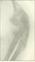 An illustration from Gunshot Roentgenograms : Acollection of Roentgenograms taken in Constantinople during the Turko-Balkan War, 1912-1913, illustrating some gunshot wounds in the Turkish Army (1916)
