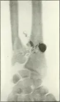 Picture 90 of 146 from Gunshot Roentgenograms : Acollection of Roentgenograms taken in Constantinople during the Turko-Balkan War, 1912-1913, illustrating some gunshot wounds in the Turkish Army (1916), leaf 216