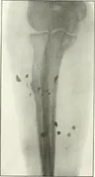 An illustration from Gunshot Roentgenograms : Acollection of Roentgenograms taken in Constantinople during the Turko-Balkan War, 1912-1913, illustrating some gunshot wounds in the Turkish Army (1916)