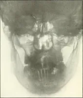 An illustration from Gunshot Roentgenograms : Acollection of Roentgenograms taken in Constantinople during the Turko-Balkan War, 1912-1913, illustrating some gunshot wounds in the Turkish Army (1916)