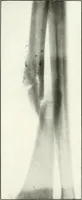 An illustration from Gunshot Roentgenograms : Acollection of Roentgenograms taken in Constantinople during the Turko-Balkan War, 1912-1913, illustrating some gunshot wounds in the Turkish Army (1916)