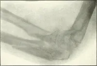 An illustration from Gunshot Roentgenograms : Acollection of Roentgenograms taken in Constantinople during the Turko-Balkan War, 1912-1913, illustrating some gunshot wounds in the Turkish Army (1916)