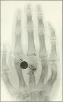An illustration from Gunshot Roentgenograms : Acollection of Roentgenograms taken in Constantinople during the Turko-Balkan War, 1912-1913, illustrating some gunshot wounds in the Turkish Army (1916)