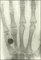 An illustration from Gunshot Roentgenograms : Acollection of Roentgenograms taken in Constantinople during the Turko-Balkan War, 1912-1913, illustrating some gunshot wounds in the Turkish Army (1916)