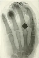 An illustration from Gunshot Roentgenograms : Acollection of Roentgenograms taken in Constantinople during the Turko-Balkan War, 1912-1913, illustrating some gunshot wounds in the Turkish Army (1916)