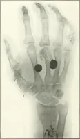 An illustration from Gunshot Roentgenograms : Acollection of Roentgenograms taken in Constantinople during the Turko-Balkan War, 1912-1913, illustrating some gunshot wounds in the Turkish Army (1916)