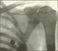 An illustration from Gunshot Roentgenograms : Acollection of Roentgenograms taken in Constantinople during the Turko-Balkan War, 1912-1913, illustrating some gunshot wounds in the Turkish Army (1916)