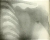 An illustration from Gunshot Roentgenograms : Acollection of Roentgenograms taken in Constantinople during the Turko-Balkan War, 1912-1913, illustrating some gunshot wounds in the Turkish Army (1916)