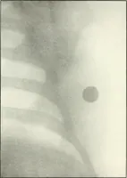An illustration from Gunshot Roentgenograms : Acollection of Roentgenograms taken in Constantinople during the Turko-Balkan War, 1912-1913, illustrating some gunshot wounds in the Turkish Army (1916)