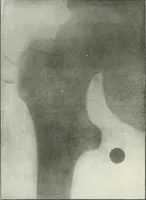 An illustration from Gunshot Roentgenograms : Acollection of Roentgenograms taken in Constantinople during the Turko-Balkan War, 1912-1913, illustrating some gunshot wounds in the Turkish Army (1916)