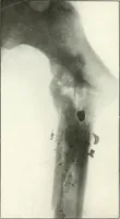 An illustration from Gunshot Roentgenograms : Acollection of Roentgenograms taken in Constantinople during the Turko-Balkan War, 1912-1913, illustrating some gunshot wounds in the Turkish Army (1916)