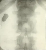 An illustration from Gunshot Roentgenograms : Acollection of Roentgenograms taken in Constantinople during the Turko-Balkan War, 1912-1913, illustrating some gunshot wounds in the Turkish Army (1916)
