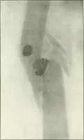 An illustration from Gunshot Roentgenograms : Acollection of Roentgenograms taken in Constantinople during the Turko-Balkan War, 1912-1913, illustrating some gunshot wounds in the Turkish Army (1916)