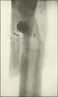An illustration from Gunshot Roentgenograms : Acollection of Roentgenograms taken in Constantinople during the Turko-Balkan War, 1912-1913, illustrating some gunshot wounds in the Turkish Army (1916)