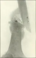 An illustration from Gunshot Roentgenograms : Acollection of Roentgenograms taken in Constantinople during the Turko-Balkan War, 1912-1913, illustrating some gunshot wounds in the Turkish Army (1916)