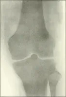 An illustration from Gunshot Roentgenograms : Acollection of Roentgenograms taken in Constantinople during the Turko-Balkan War, 1912-1913, illustrating some gunshot wounds in the Turkish Army (1916)