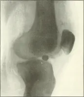 An illustration from Gunshot Roentgenograms : Acollection of Roentgenograms taken in Constantinople during the Turko-Balkan War, 1912-1913, illustrating some gunshot wounds in the Turkish Army (1916)