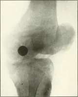 An illustration from Gunshot Roentgenograms : Acollection of Roentgenograms taken in Constantinople during the Turko-Balkan War, 1912-1913, illustrating some gunshot wounds in the Turkish Army (1916)