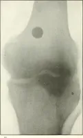 An illustration from Gunshot Roentgenograms : Acollection of Roentgenograms taken in Constantinople during the Turko-Balkan War, 1912-1913, illustrating some gunshot wounds in the Turkish Army (1916)