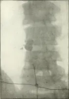An illustration from Gunshot Roentgenograms : Acollection of Roentgenograms taken in Constantinople during the Turko-Balkan War, 1912-1913, illustrating some gunshot wounds in the Turkish Army (1916)