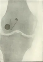 Picture 116 of 146 from Gunshot Roentgenograms : Acollection of Roentgenograms taken in Constantinople during the Turko-Balkan War, 1912-1913, illustrating some gunshot wounds in the Turkish Army (1916), leaf 280