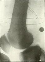 An illustration from Gunshot Roentgenograms : Acollection of Roentgenograms taken in Constantinople during the Turko-Balkan War, 1912-1913, illustrating some gunshot wounds in the Turkish Army (1916)