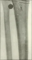 An illustration from Gunshot Roentgenograms : Acollection of Roentgenograms taken in Constantinople during the Turko-Balkan War, 1912-1913, illustrating some gunshot wounds in the Turkish Army (1916)