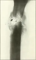 An illustration from Gunshot Roentgenograms : Acollection of Roentgenograms taken in Constantinople during the Turko-Balkan War, 1912-1913, illustrating some gunshot wounds in the Turkish Army (1916)