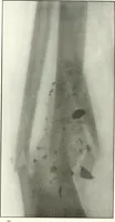 An illustration from Gunshot Roentgenograms : Acollection of Roentgenograms taken in Constantinople during the Turko-Balkan War, 1912-1913, illustrating some gunshot wounds in the Turkish Army (1916)