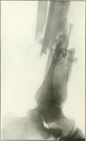 An illustration from Gunshot Roentgenograms : Acollection of Roentgenograms taken in Constantinople during the Turko-Balkan War, 1912-1913, illustrating some gunshot wounds in the Turkish Army (1916)