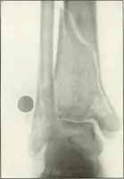 An illustration from Gunshot Roentgenograms : Acollection of Roentgenograms taken in Constantinople during the Turko-Balkan War, 1912-1913, illustrating some gunshot wounds in the Turkish Army (1916)