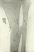 An illustration from Gunshot Roentgenograms : Acollection of Roentgenograms taken in Constantinople during the Turko-Balkan War, 1912-1913, illustrating some gunshot wounds in the Turkish Army (1916)