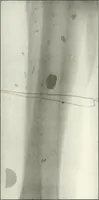 An illustration from Gunshot Roentgenograms : Acollection of Roentgenograms taken in Constantinople during the Turko-Balkan War, 1912-1913, illustrating some gunshot wounds in the Turkish Army (1916)
