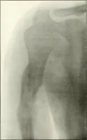 An illustration from Gunshot Roentgenograms : Acollection of Roentgenograms taken in Constantinople during the Turko-Balkan War, 1912-1913, illustrating some gunshot wounds in the Turkish Army (1916)