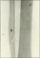 An illustration from Gunshot Roentgenograms : Acollection of Roentgenograms taken in Constantinople during the Turko-Balkan War, 1912-1913, illustrating some gunshot wounds in the Turkish Army (1916)