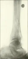 An illustration from Gunshot Roentgenograms : Acollection of Roentgenograms taken in Constantinople during the Turko-Balkan War, 1912-1913, illustrating some gunshot wounds in the Turkish Army (1916)