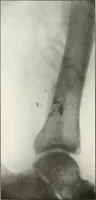 An illustration from Gunshot Roentgenograms : Acollection of Roentgenograms taken in Constantinople during the Turko-Balkan War, 1912-1913, illustrating some gunshot wounds in the Turkish Army (1916)