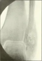 An illustration from Gunshot Roentgenograms : Acollection of Roentgenograms taken in Constantinople during the Turko-Balkan War, 1912-1913, illustrating some gunshot wounds in the Turkish Army (1916)